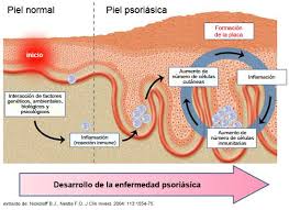 La Psoriasis y la Artritis Psoriasica son una enfermedad crónica de la piel. El diagnóstico precoz es fundamental. 